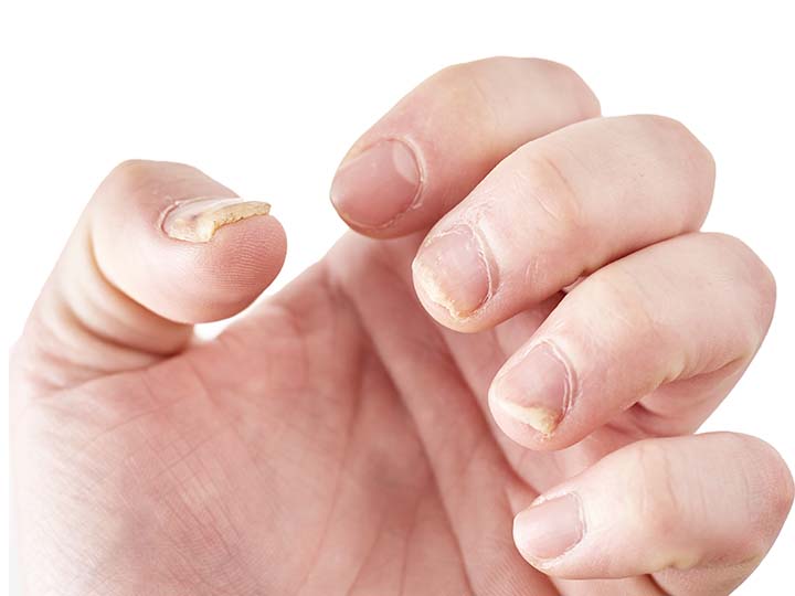 How to Get Rid of Nail Fungus: Simple Remedies That Work - Mersi Cosmetics